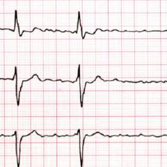 EKG bei Vorhofflimmern