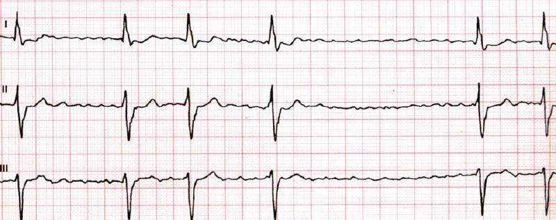 EKG bei Vorhofflimmern