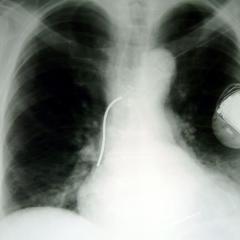 Röntgenbild eines Defibrillators (ICD)