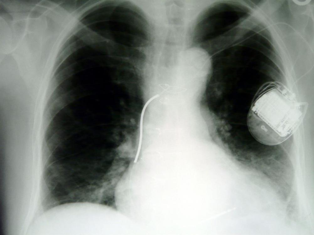 Röntgenbild eines Defibrillators (ICD)