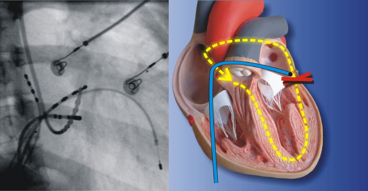 Elektrophysiologische Untersuchung und Ablation